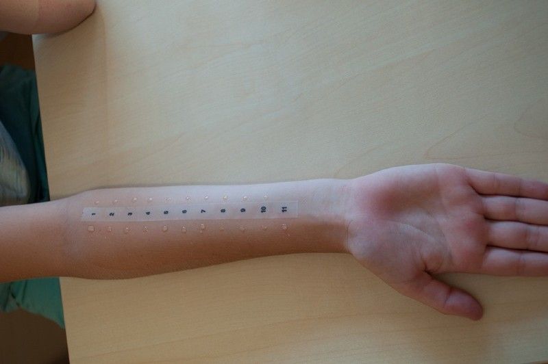 Allergietest